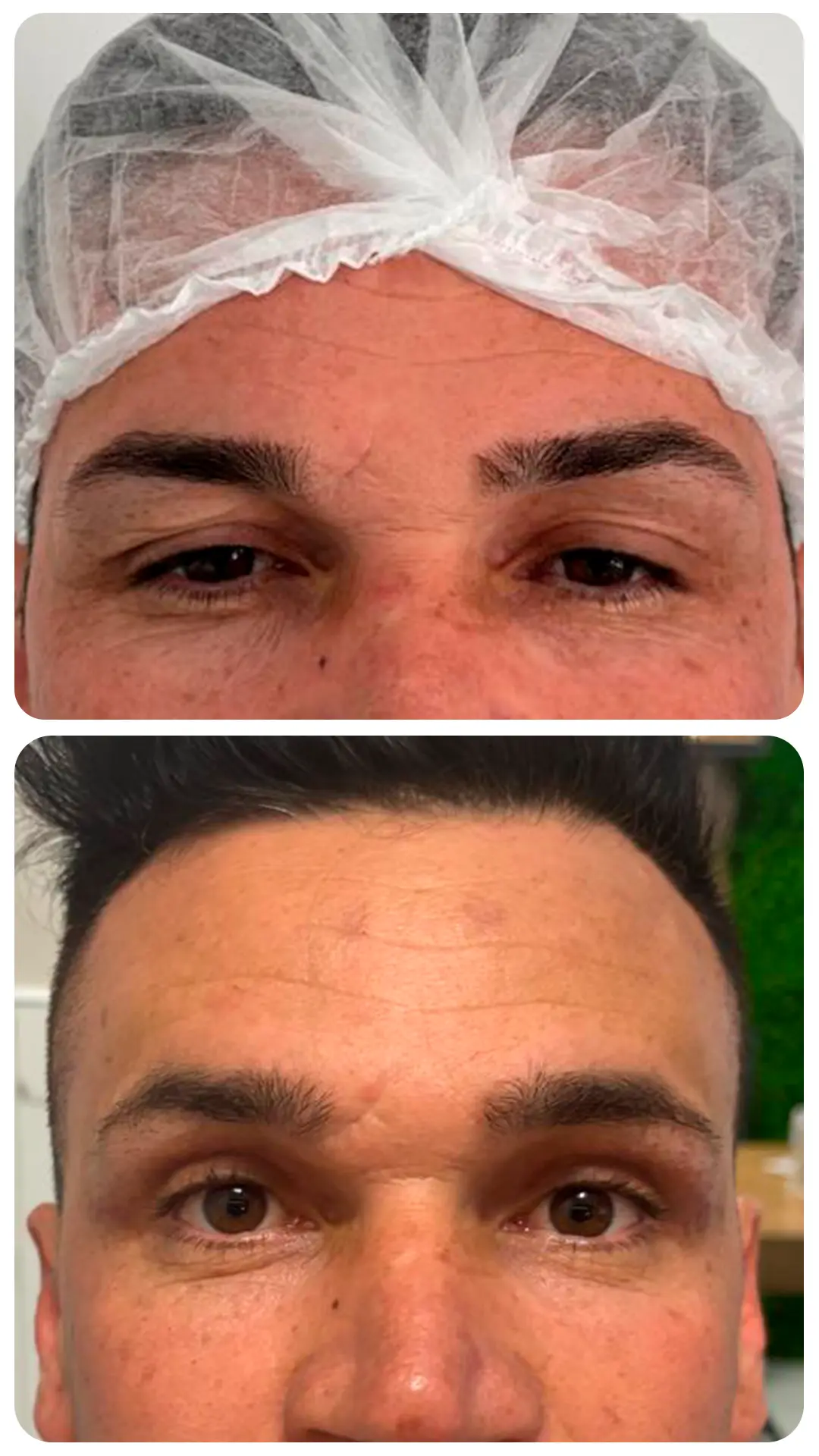 Blefaroplastia — antes e depois (caso 1)
