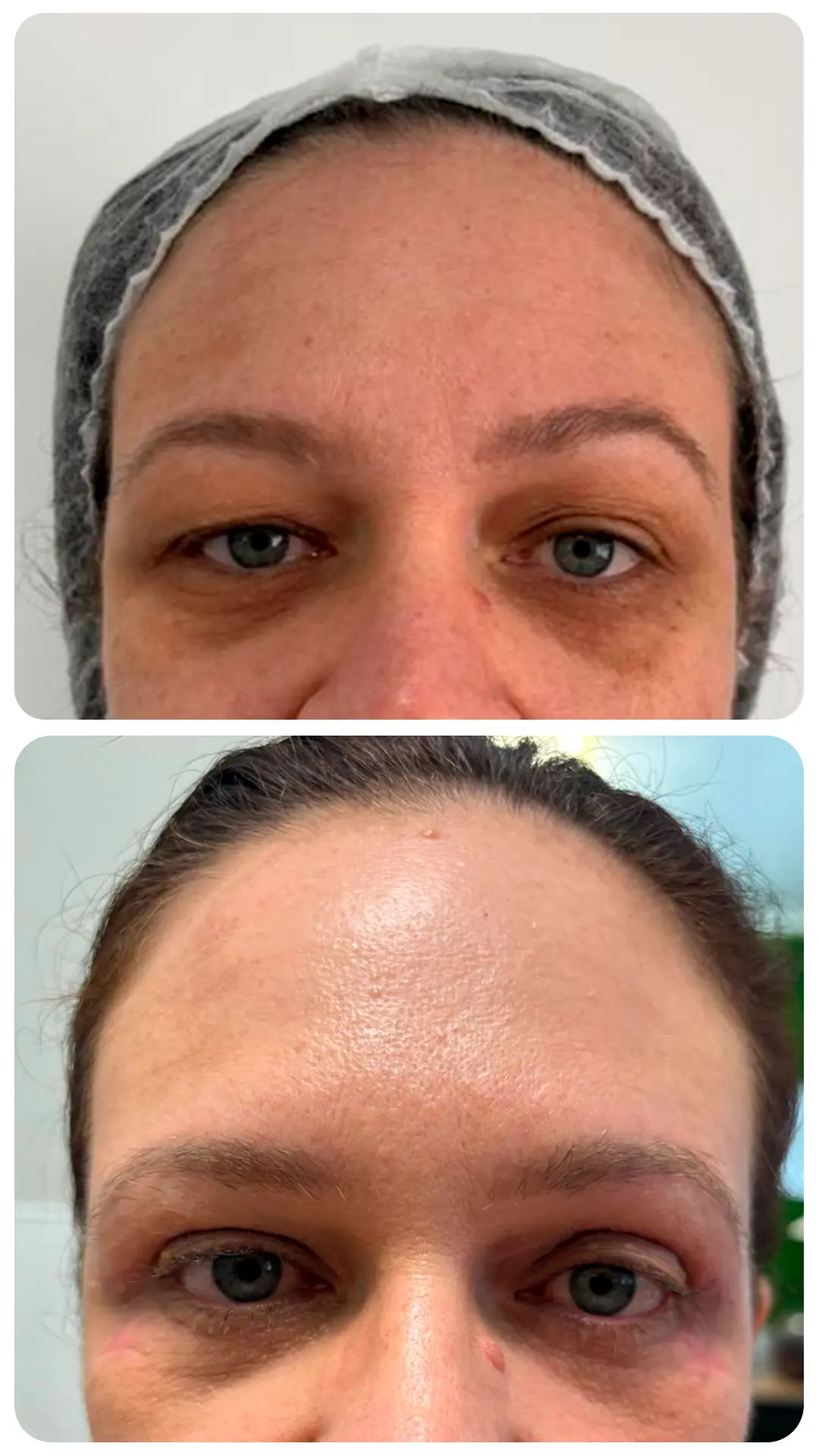 Blefaroplastia — antes e depois (caso 2)