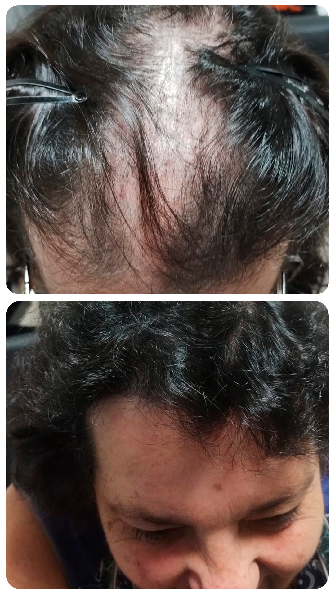 Transplante capilar feminino — antes e depois (caso 1)