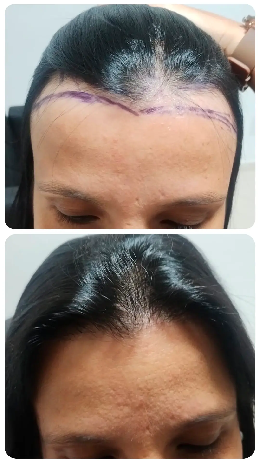 Transplante capilar feminino — antes e depois (caso 2)