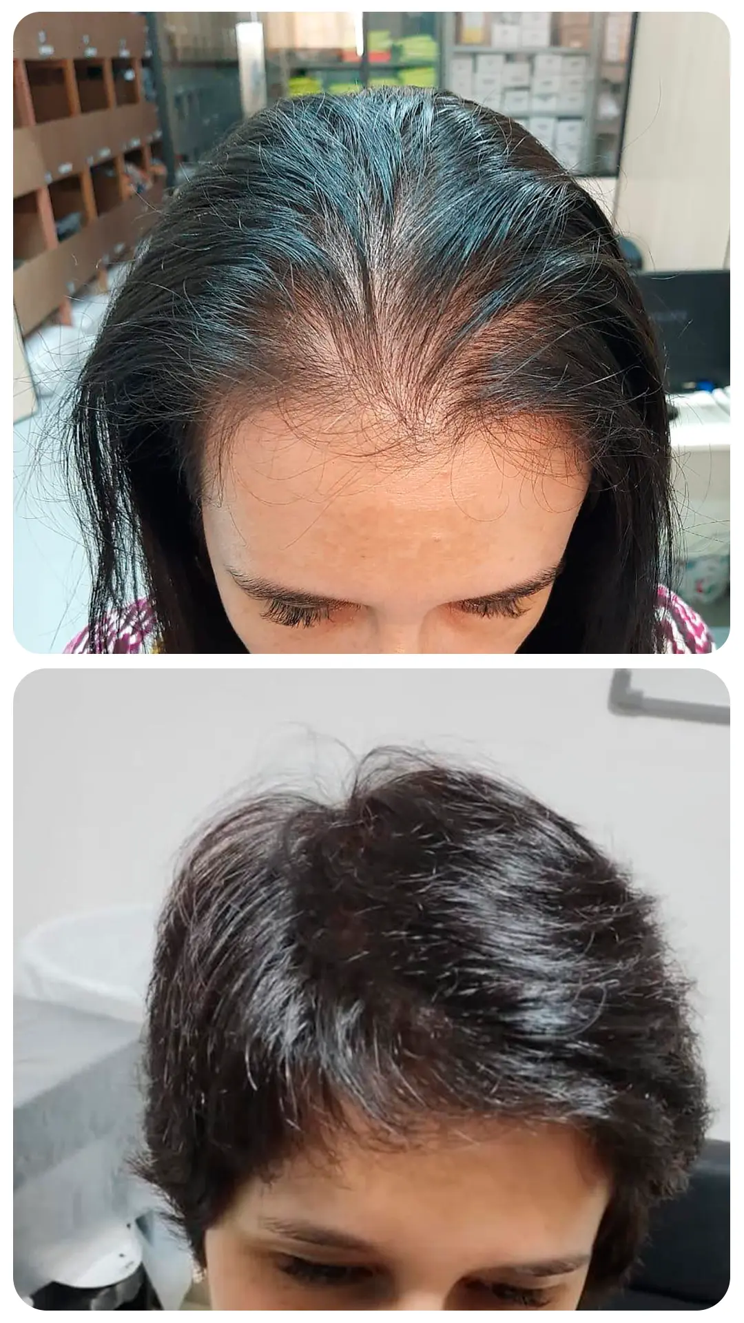 Transplante capilar feminino — antes e depois (caso 3)