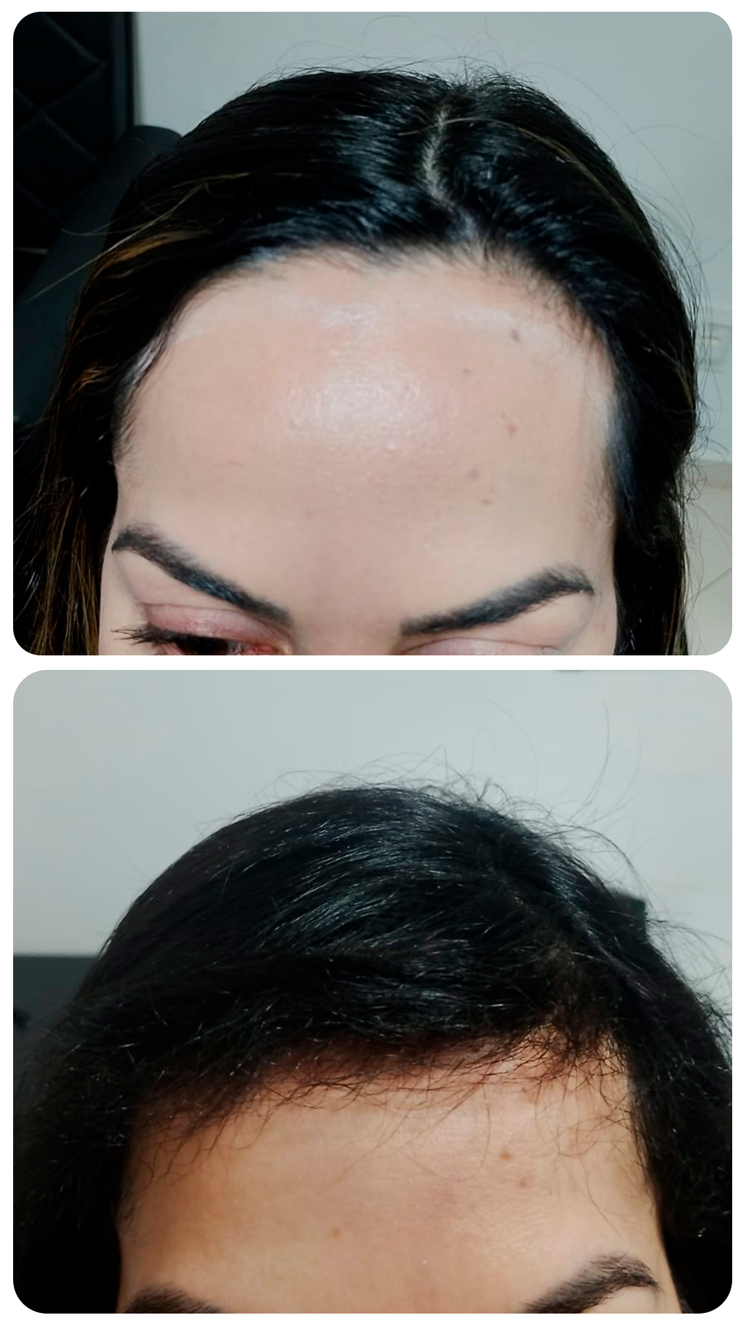 Transplante capilar feminino — antes e depois (caso 4)