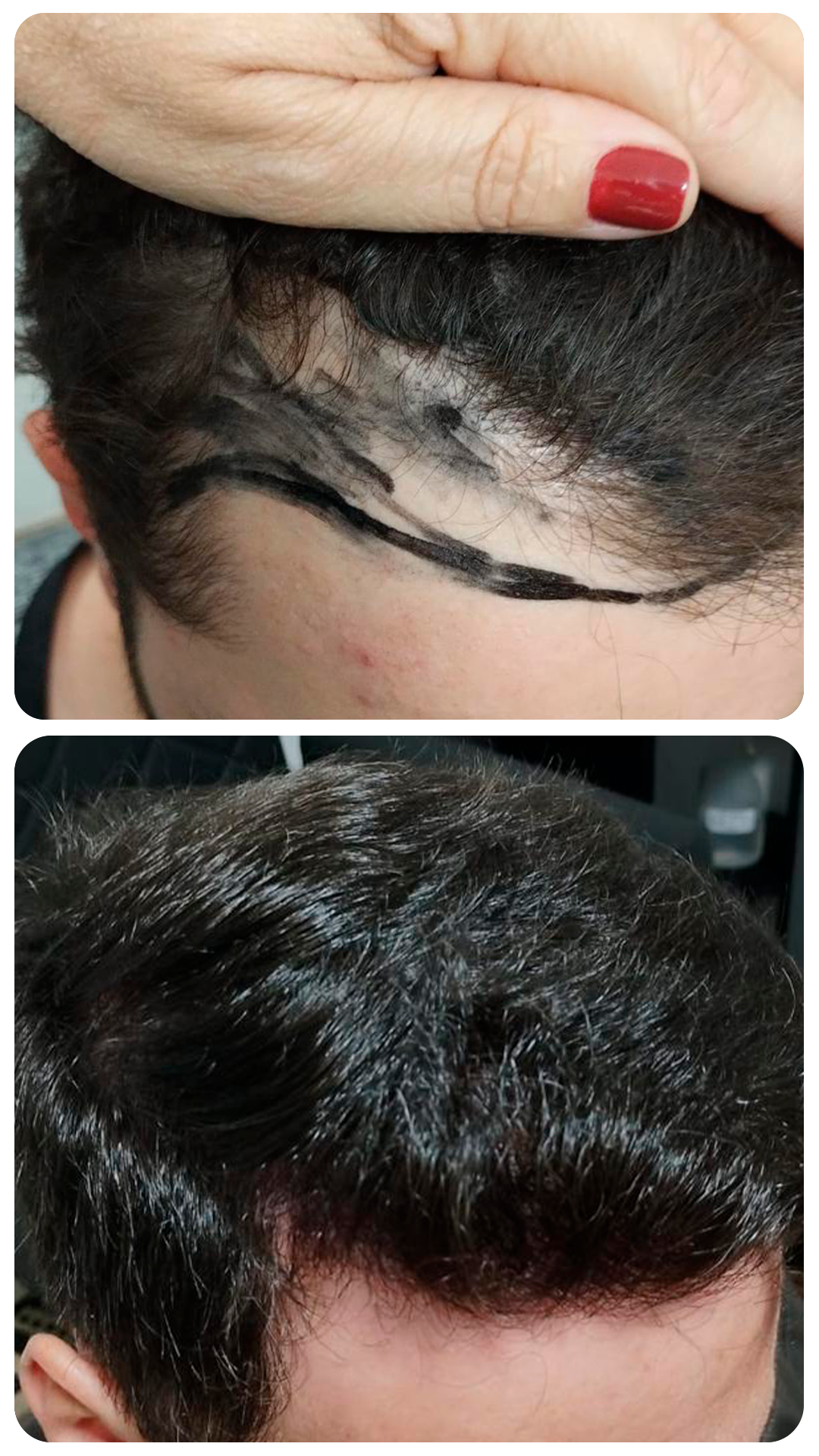 Transplante capilar masculino — antes e depois (caso 2)