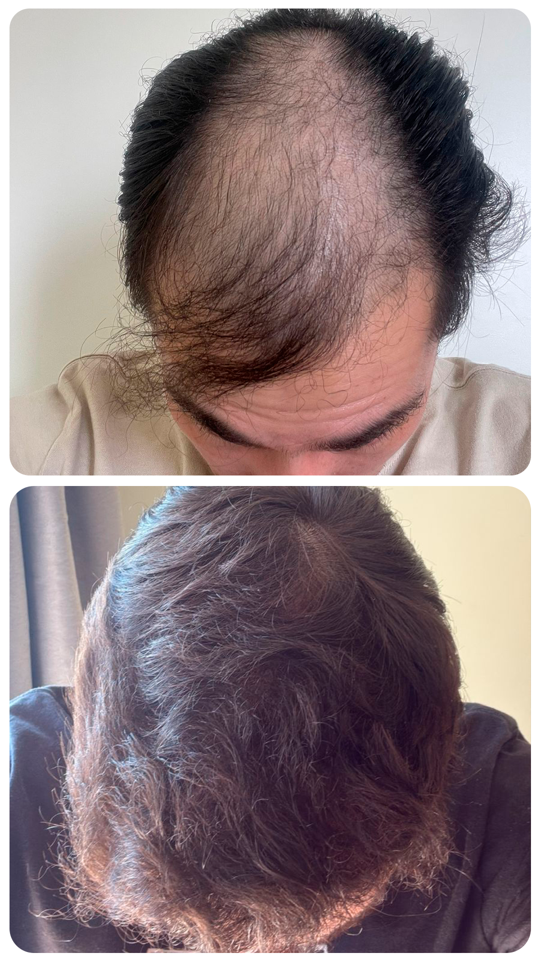 Transplante capilar masculino — antes e depois (caso 4)