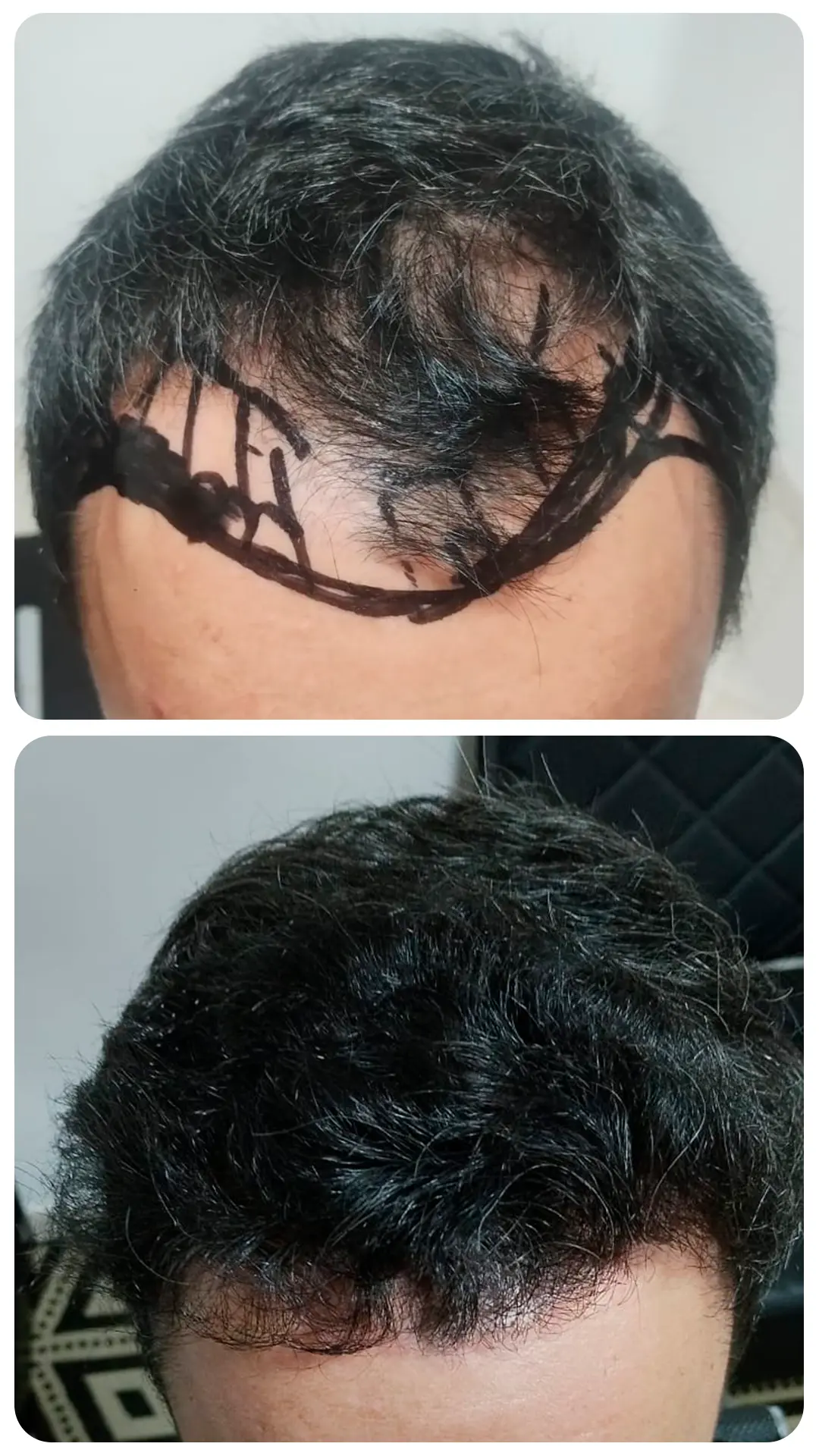 Transplante capilar masculino — antes e depois (caso 5)